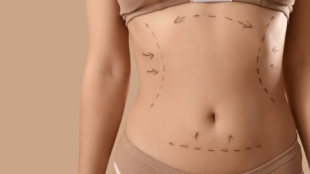 Abdominoplasty Surgery: 5 Benefits 1 Abdominoplasty Surgery