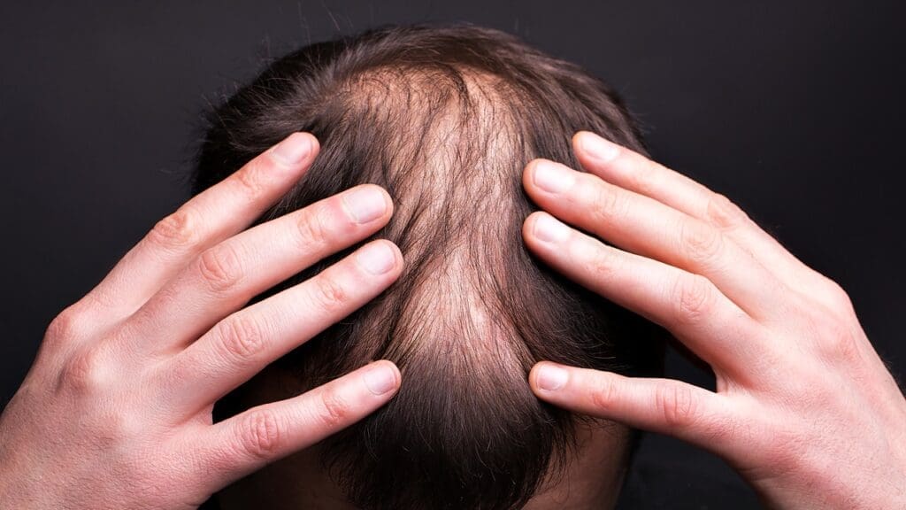 Diabetes Cause Hair Loss