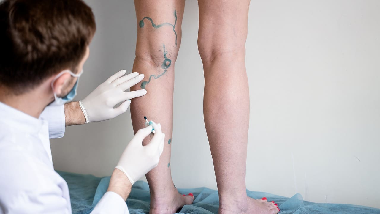 vein markup vascular surgeon is marking veins varicose surgery yt thumbnail 1280 720 LIV Hospital