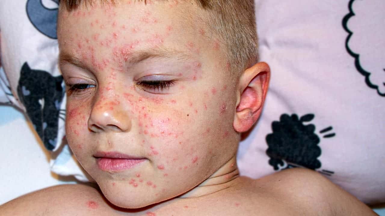 Pediatric Rheumatology