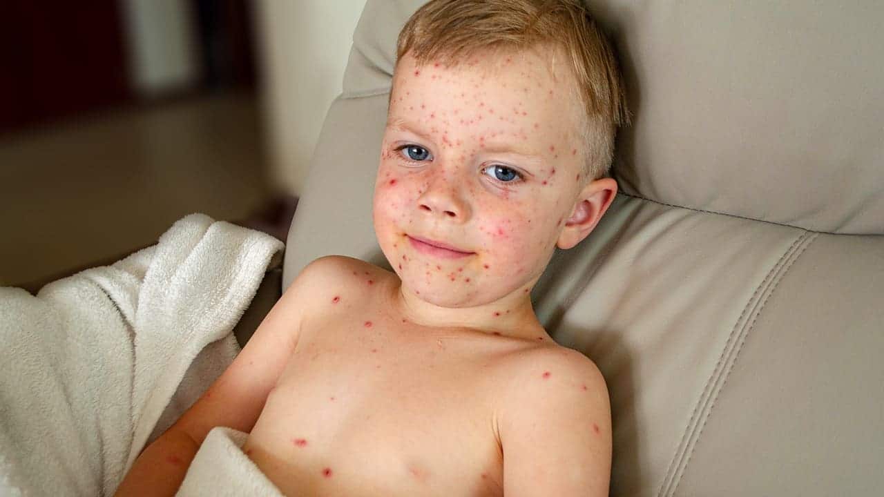 natural vaccination contagious disease yt thumbnail 1280 720 LIV Hospital