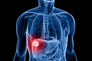 How Long Is Recovery Time for Liver Tumor Surgery When Doctor Removed Liver During Surgery