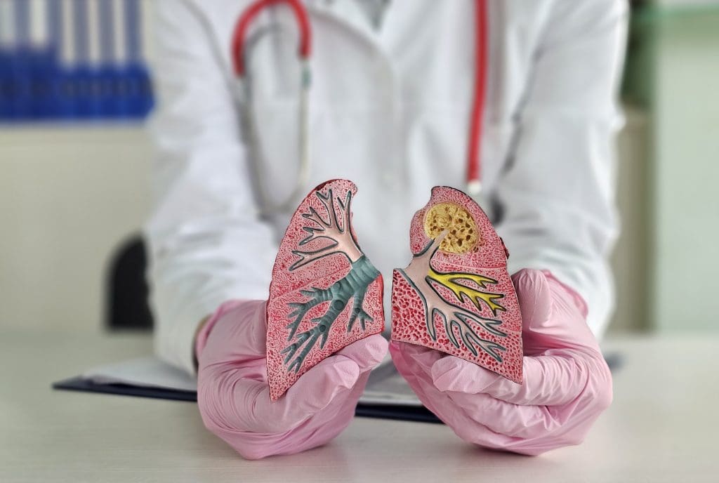 At What Stage is Lung Cancer Most Curable? 1 At what stage is lung cancer most curable