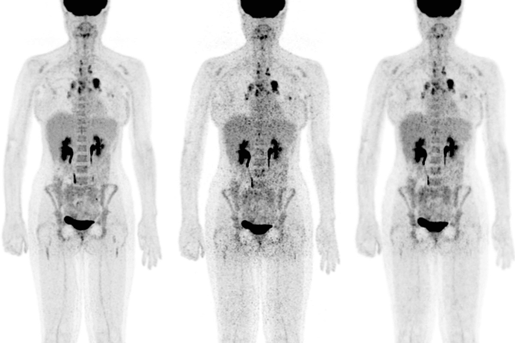 Cancers Not Visible on PET Scans: Important Limitations