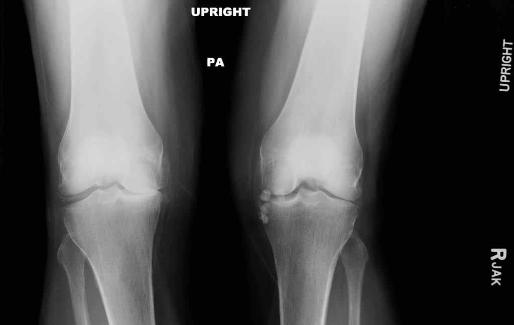 Osteoarthritis Scan: Powerful Tool for Joint Health Assessment
