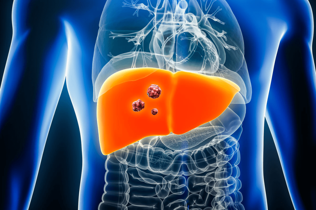 Is Hepatoblastoma Genetic? Causes and Family Risk Factors
