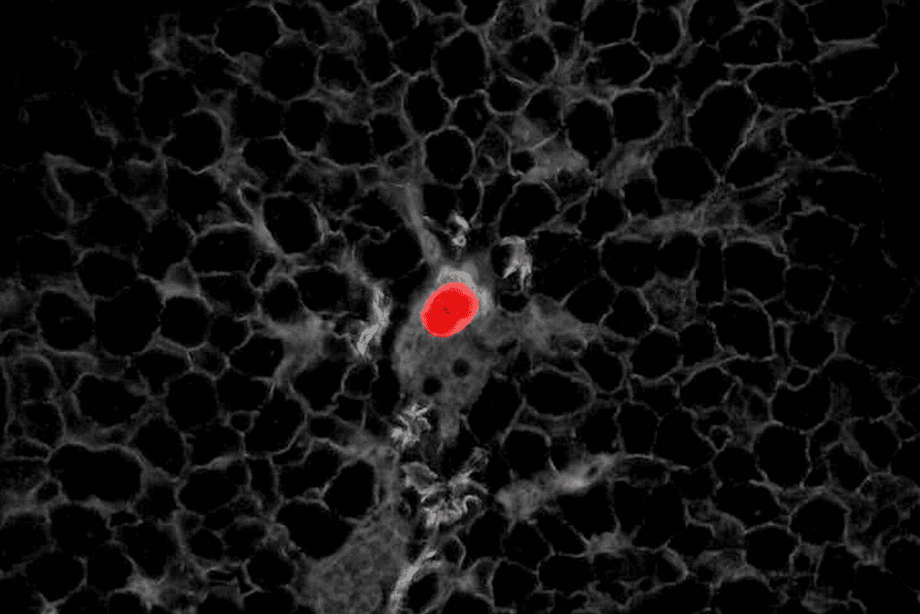 Cancers Detected by PET Scan: Types of Tumors Visible on Imaging 2 Cancers detected by PET scan