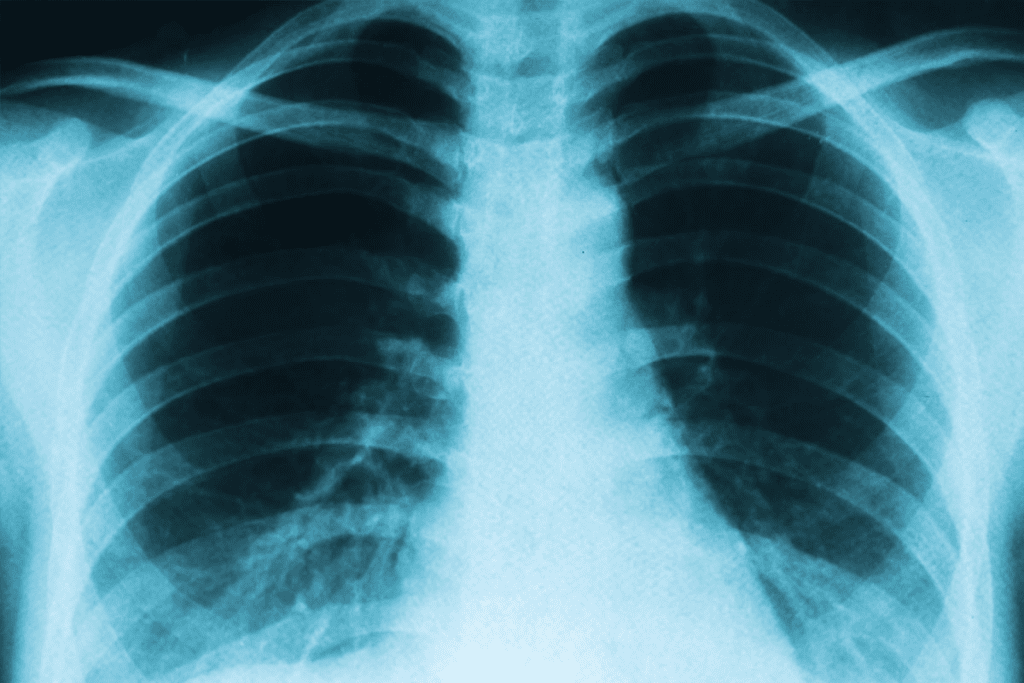 Why doctor recommend PET scan