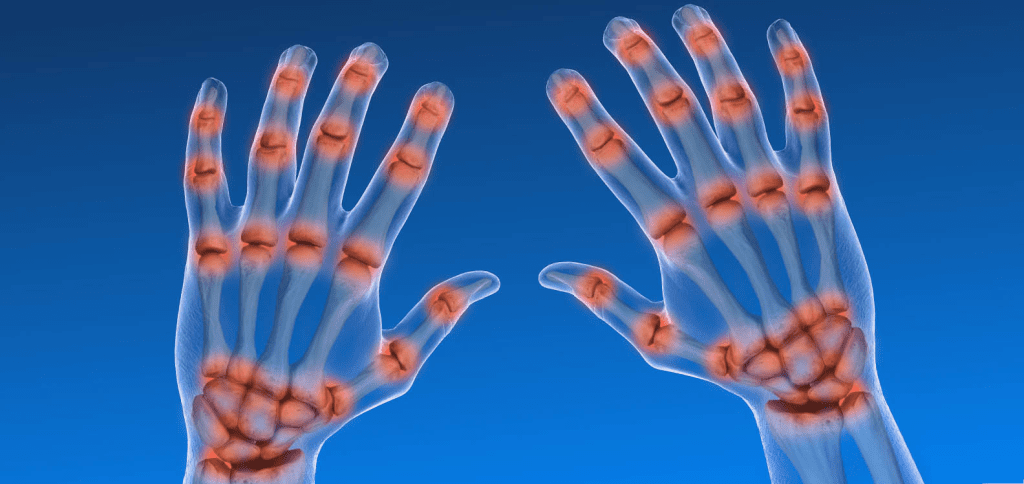 Arthritis Confirming Scan: Powerful Detection for Early Diagnosis