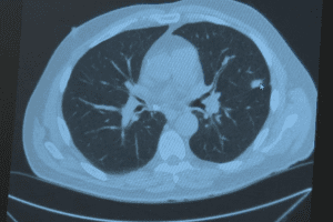 Absolutely: Can PET Scan Detect Cancer Better Than CT Scan