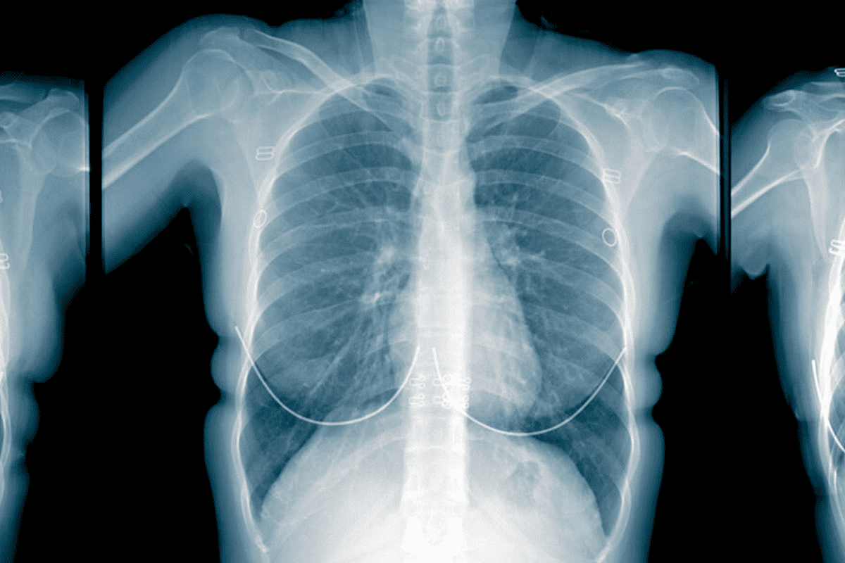 PET Scan Lung Mass Cancer Detection Accuracy