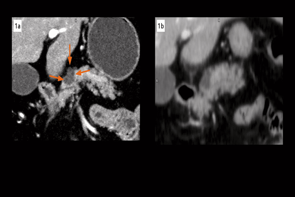 Cancerous Lung Nodule Locations: Where Malignant Nodules Often Appear