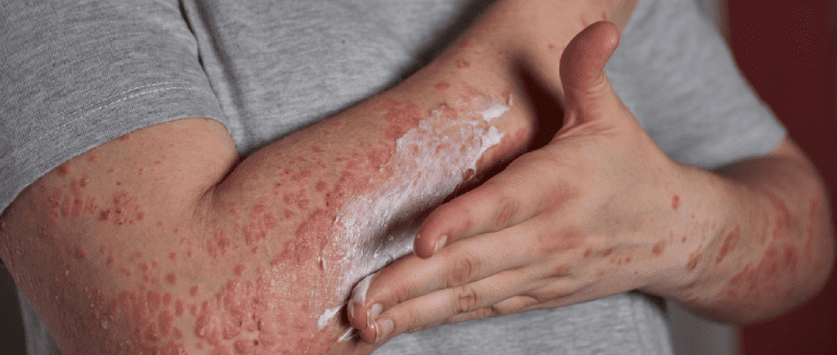 5 Effective Ways to Treat Actinic Keratosis 4 Actinic Keratosis