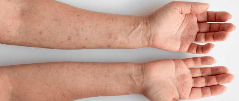 5 Effective Ways to Treat Actinic Keratosis 2 Actinic Keratosis