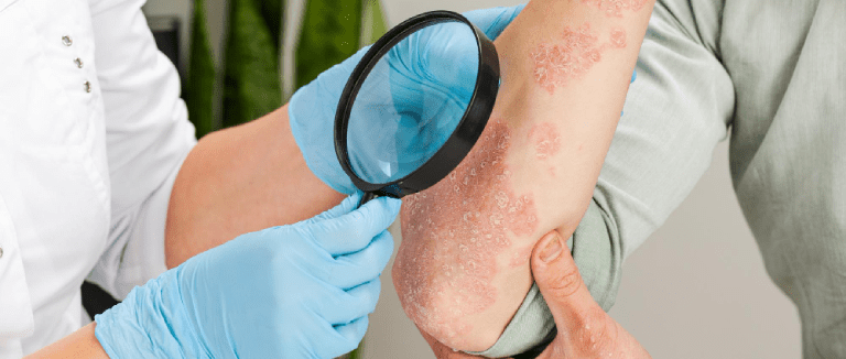 5 Effective Ways to Treat Actinic Keratosis 3 Actinic Keratosis
