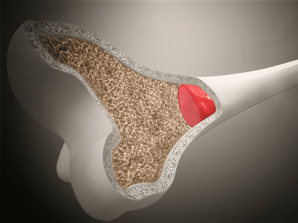 Bone Marrow: Powerful Source of Stem Cells for Healing