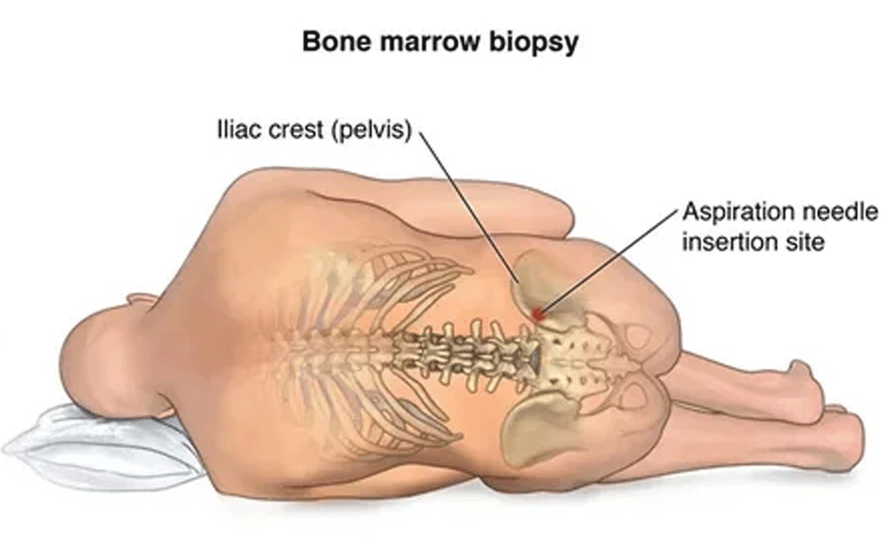 Bone Marrow Transplant Side Effects: Manage Risks & Recovery