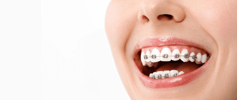 Orthodontics: Perfect Smile Transformation 3 orthodontics