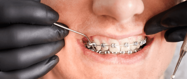 Orthodontics: Perfect Smile Transformation 4 orthodontics