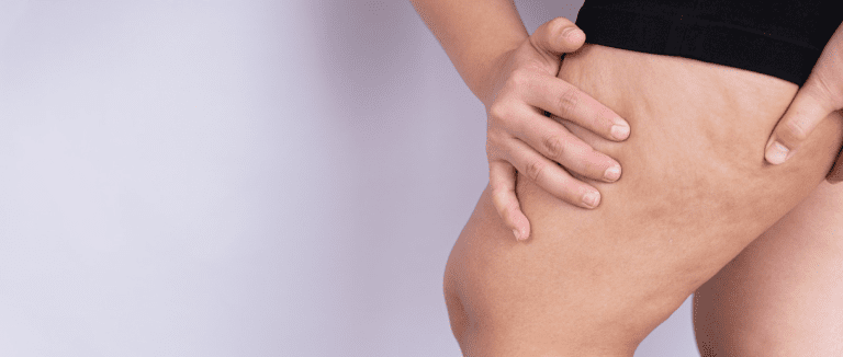 7 Essential Cellulitis Facts You Must Know 1 Cellulitis