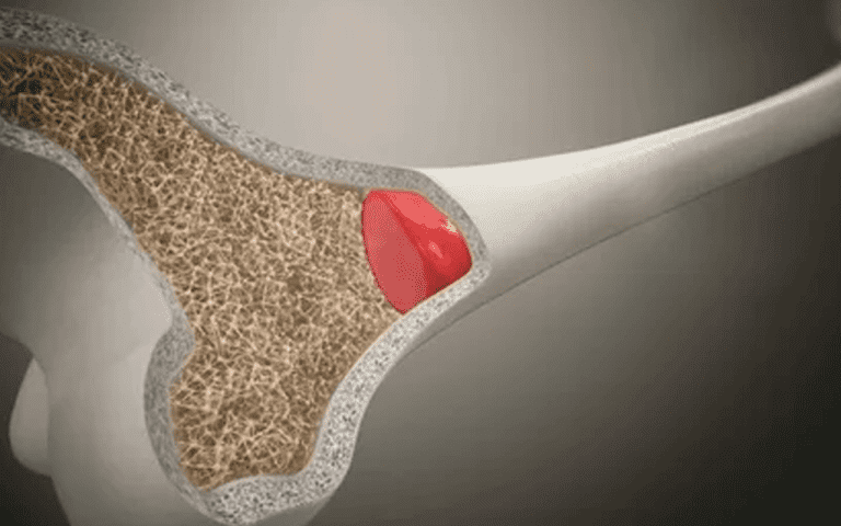 What is a Bone Scan? Procedure, Uses, and Results Explained