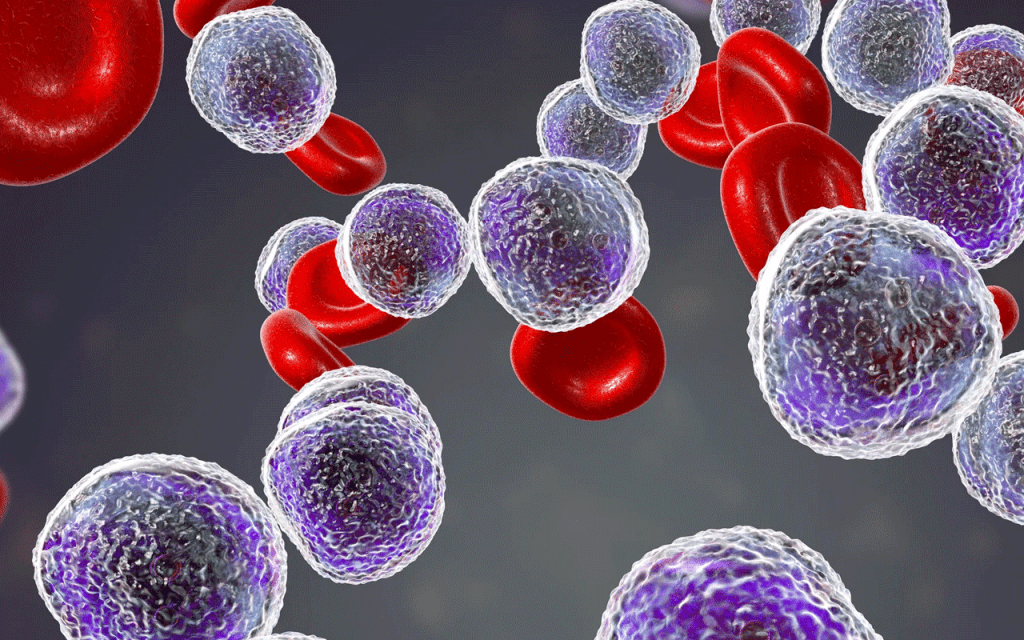 Leukemia Survival Rate: Hopeful Advances for 2025