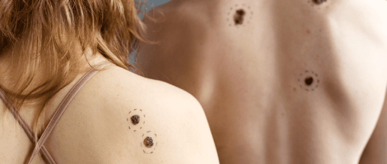 Common Skin Cancer Symptoms 2 Skin cancer symptoms