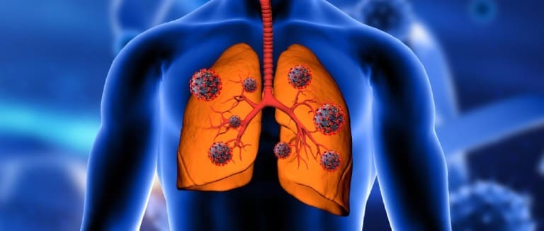 Broncholithiasis: Complete Guide & Care Tips 4 Broncholithiasis