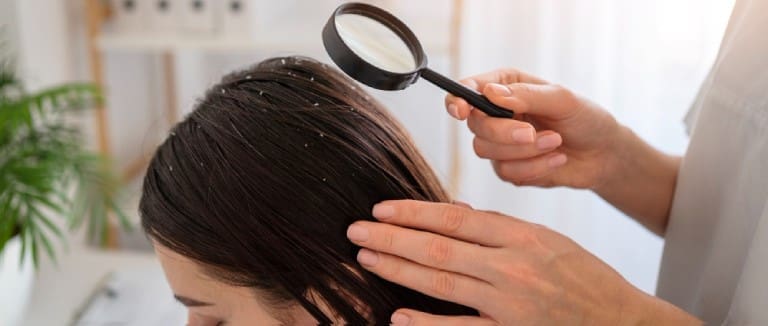 Scalp eczema
