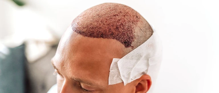 Hair Transplant Turkey