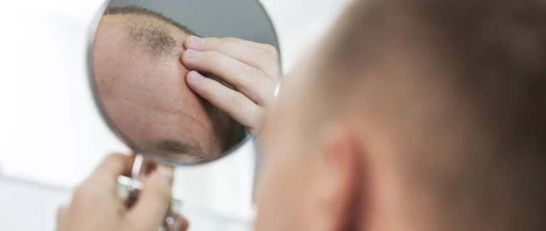 Fue Hair Transplant
