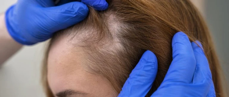 Fue Hair Transplant