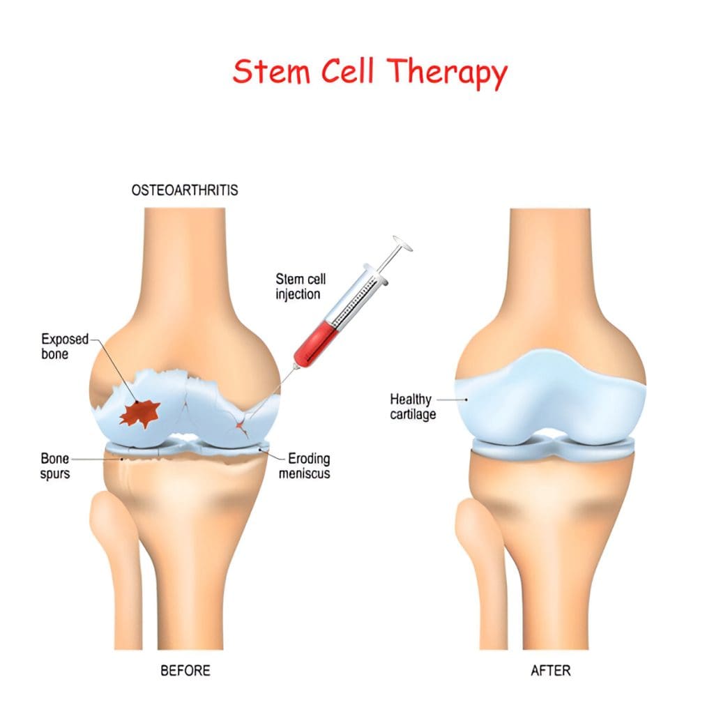 How can I regenerate my bone marrow naturally? The Complete Guide to Stem Regen 2 stem regen