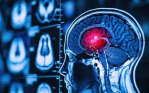 Meningioma: Essential Facts & Care Guide