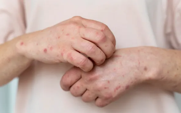 Health Guide 2 Monkeypox Virus: Essential Facts & Care