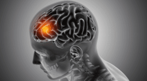 Brain Tumor Symptoms: Absolute Guide