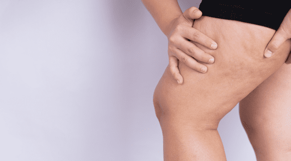 7 Essential Cellulitis Facts You Must Know