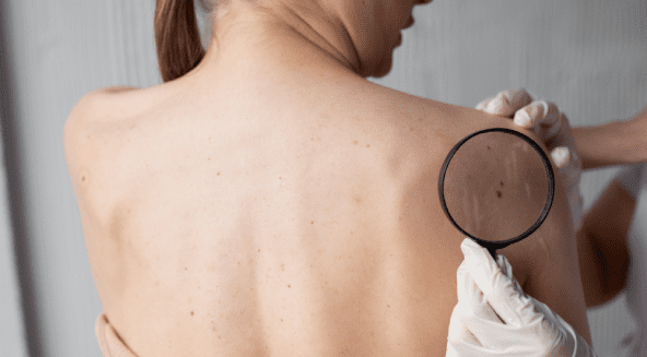 Common Skin Cancer Symptoms