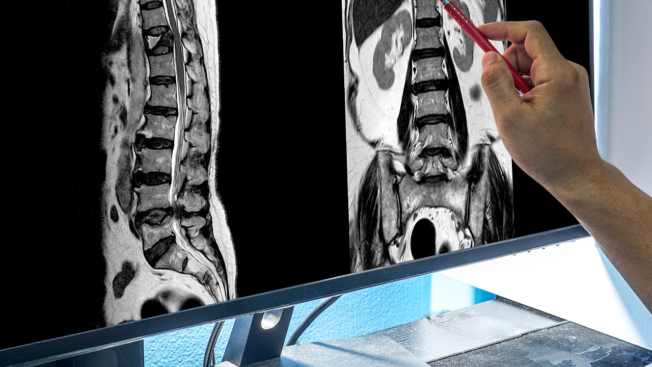 L4 L5 Spinal Stenosis: 7 Comfortable Treatments 3 Spinal Stenosis