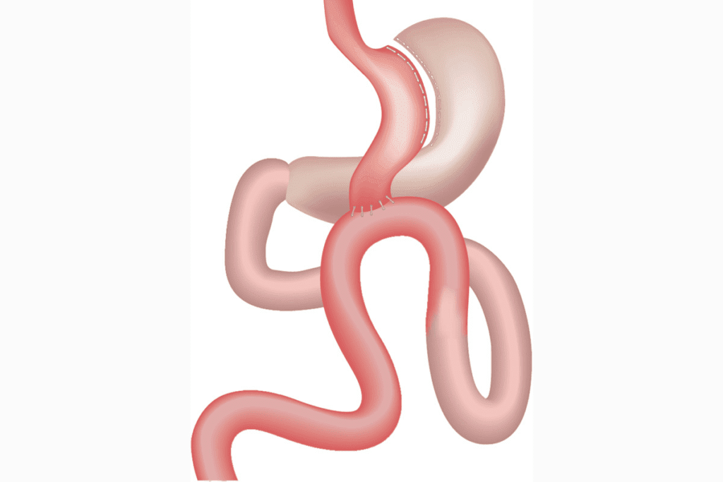 Procedure And Complications Of Stomach Bypass Reversal