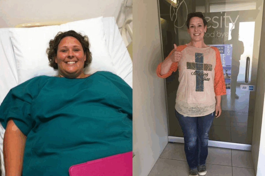 15 Real Gastric Bypass Surgery Reviews And Results