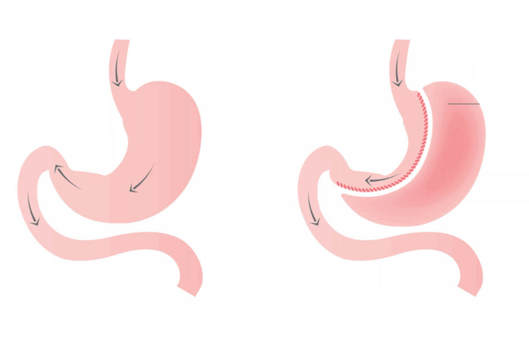 Guide To Eating Corn After Gastric Sleeve