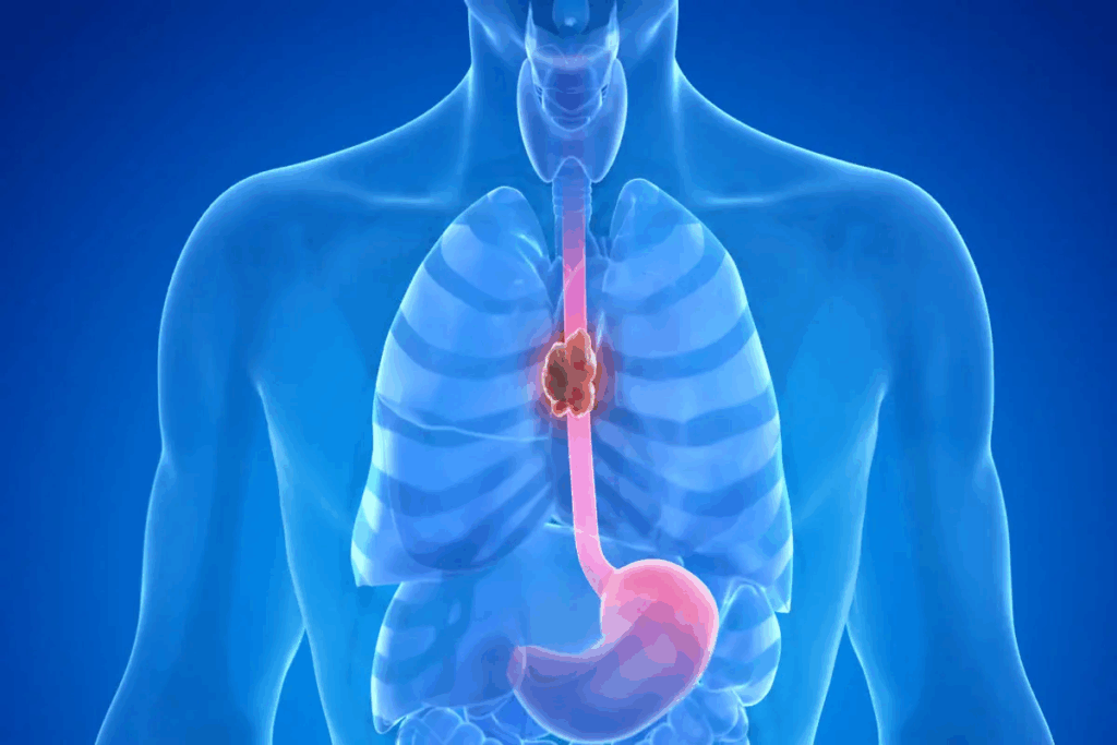 Treatment Options For Esophagus Ring Surgery 1 Treatment Options For Esophagus Ring Surgery