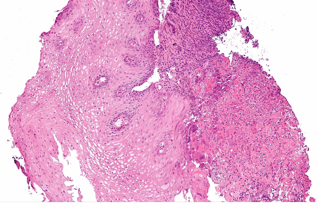 15 Schatzki Ring Foods To Avoid List