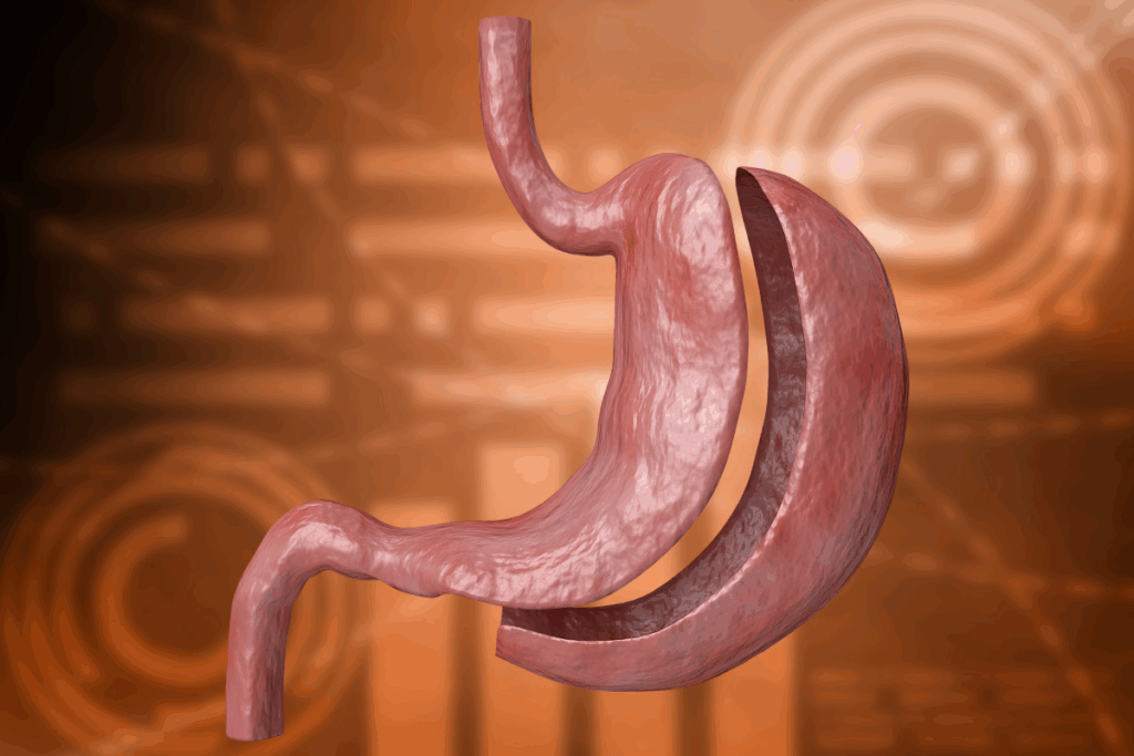 The Shocking Truth About Gastric Bypass Mortality Rates 1 The Shocking Truth About Gastric Bypass Mortality Rates