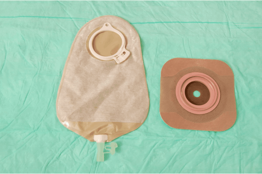 7 Key Types Of Ileostomy Diversion