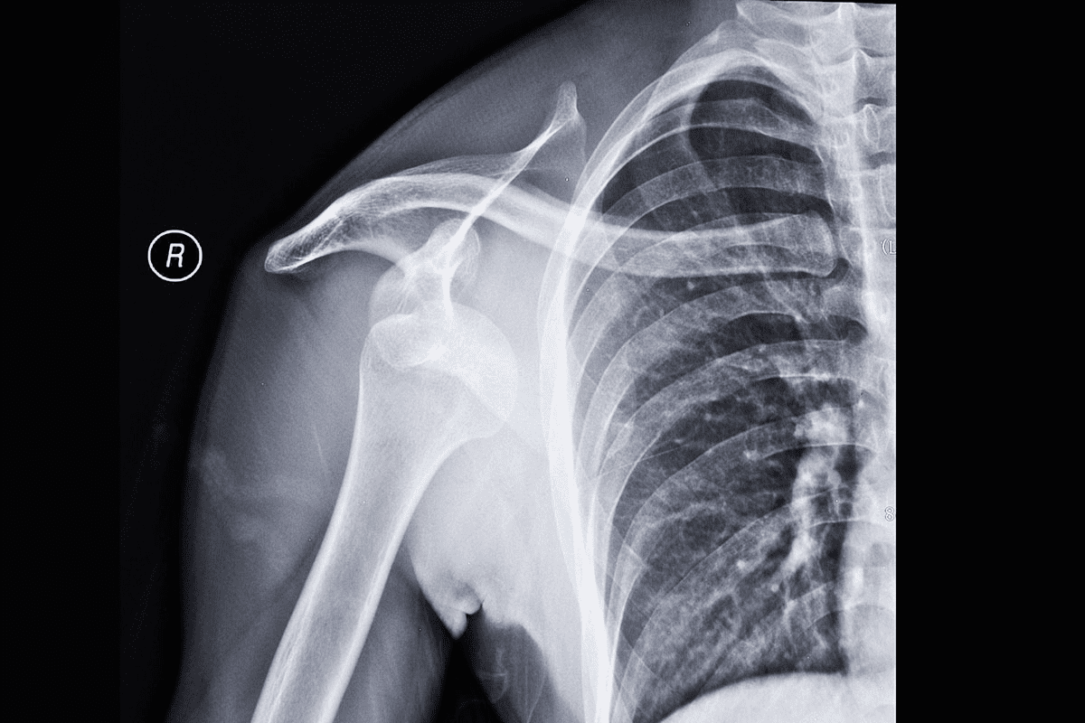 How to Fix Shoulder Dislocation Safely