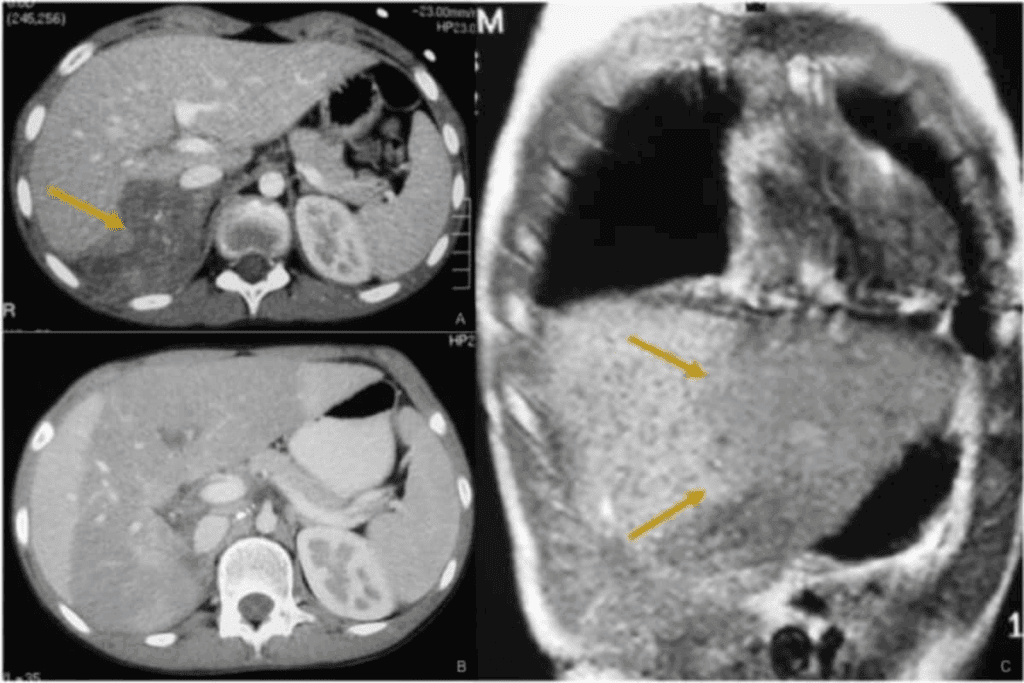Most Common Solid Tumor Children