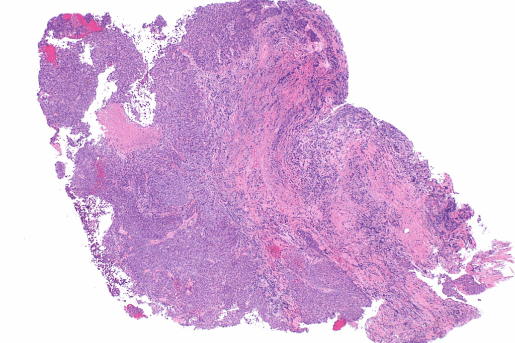What Is Neuroblastoma Children