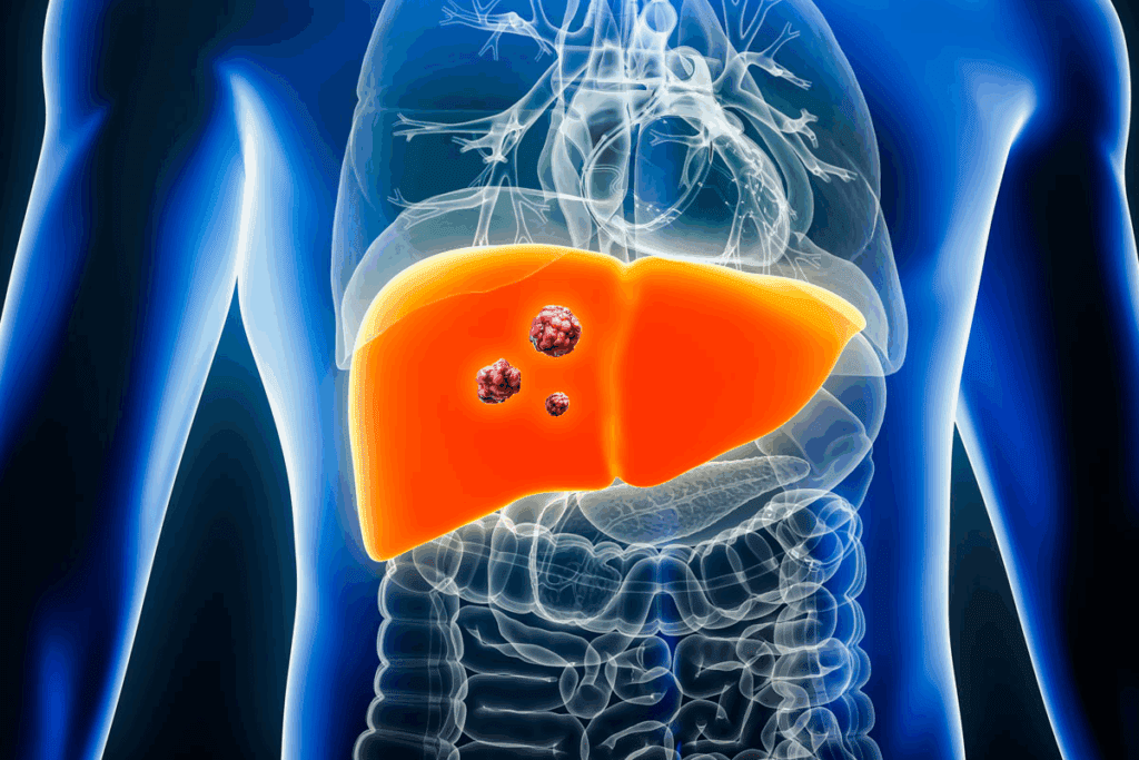 Hepatoblastoma Recurrence: Worst Case Scenario & Powerful Prevention